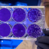 Scoperta la causa della sclerosi multipla: virus e predisposizione genetica è il mix che manda in tilt i neuroni
