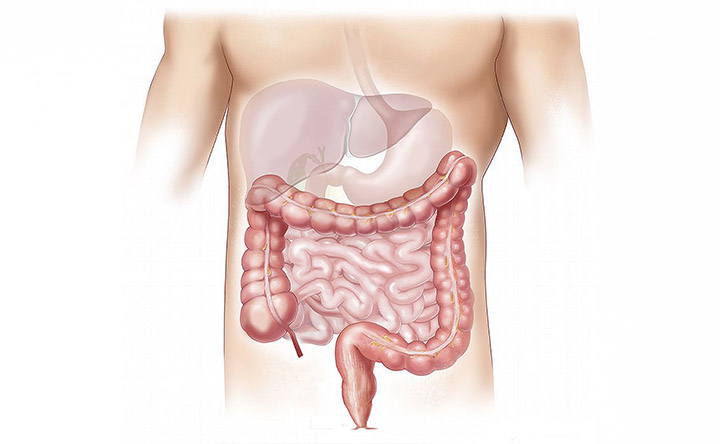 Cancro al colon: nuovo esame per la diagnosi precoce