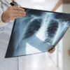 Tumore al polmone: la prevenzione personalizzata