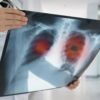 Tumore ai polmoni: in Italia un nuovo screening gratuito