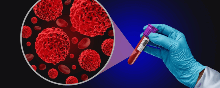 Caccia al “nemico invisibile”: la Biopsia Liquida e la rivoluzione dello stadio zero